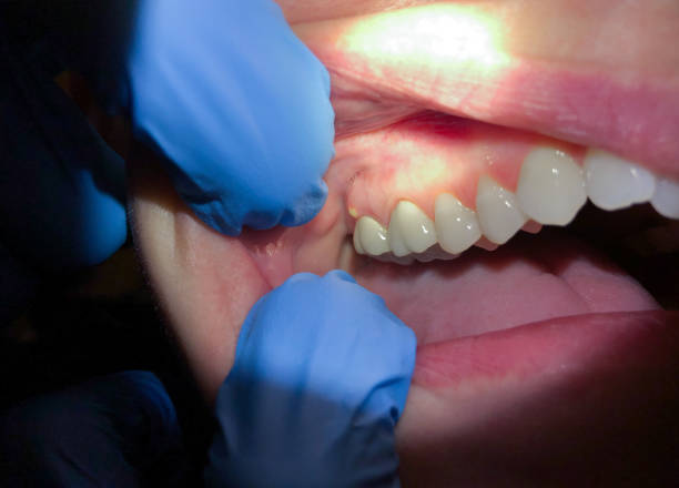 Best Emergency Gum Treatment in Ferndale, MD